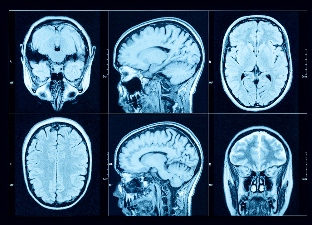 Depo-Provera Brain Tumor Caused Numbness Over Half of Woman’s Body, Lawsuit Alleges