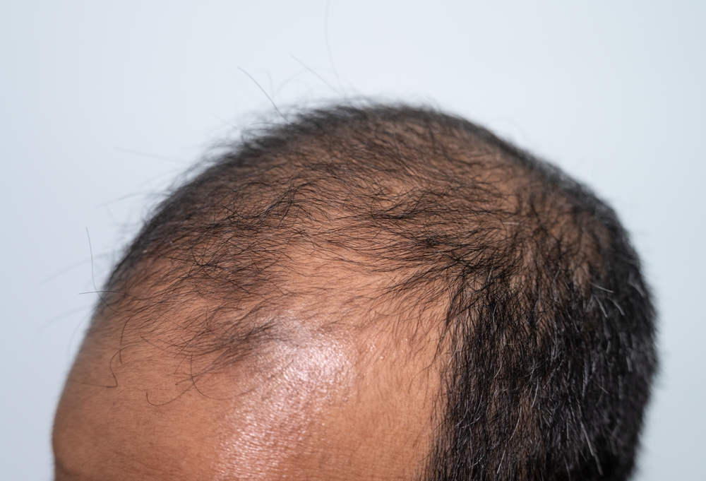 Hair Loss Drug Propecia’s Depression, Suicide Risks Overlooked for Years: Report